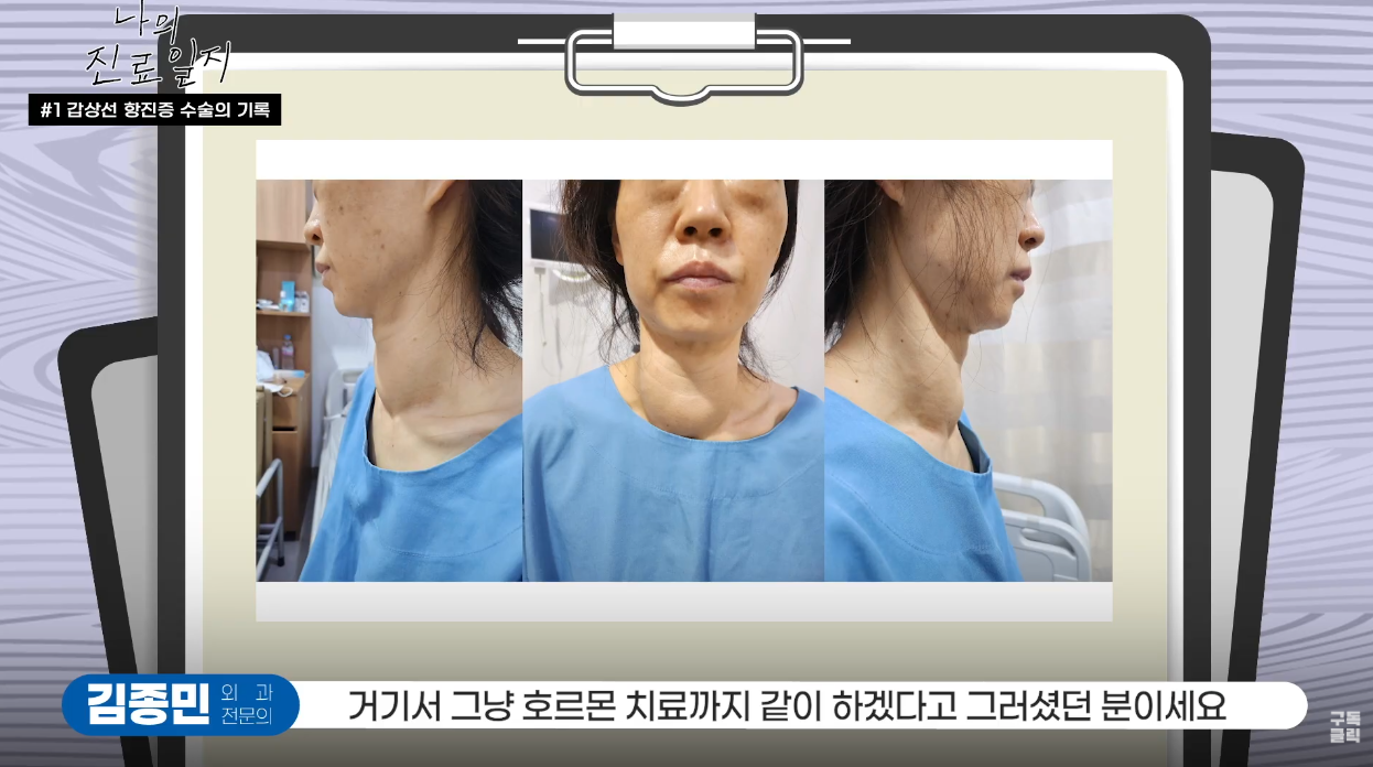 [증례] 갑상선 항진증 악화로 안구돌출까지, 약물 한계 이후 내시경 수술로..