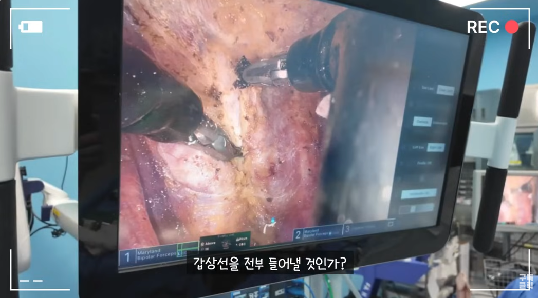[증례] 갑상선 전절제를 권유받았지만, 수술 중 검사로 한쪽을 보존한 사례..