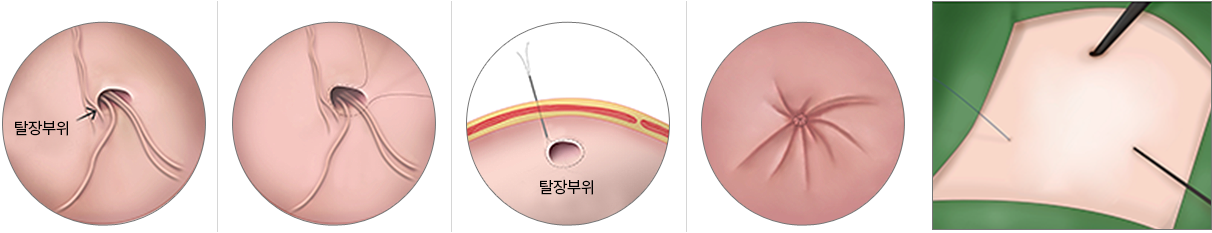 소아탈장 복강경 경피적 봉합술