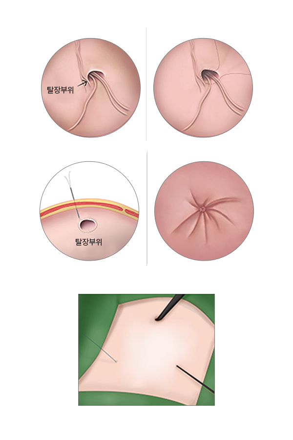 소아탈장 복강경 경피적 봉합술