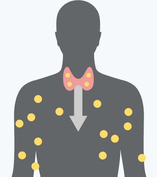 갑상선기능항진증