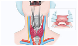 갑상선 내시경 수술방법