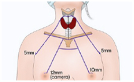 갑상선 내시경 수술방법