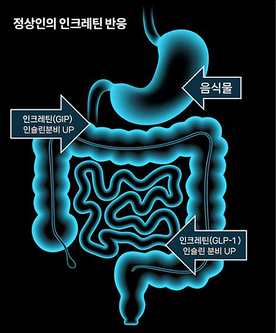 당뇨대사수술 원리