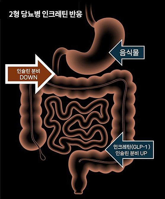 당뇨대사수술 원리