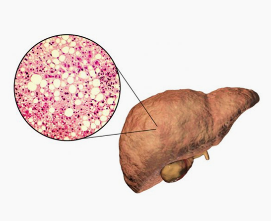 지방간이란?
