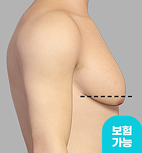 여유증 단계