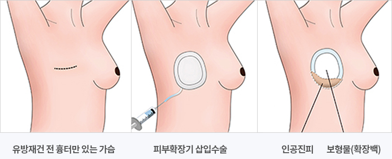 당뇨병 진단