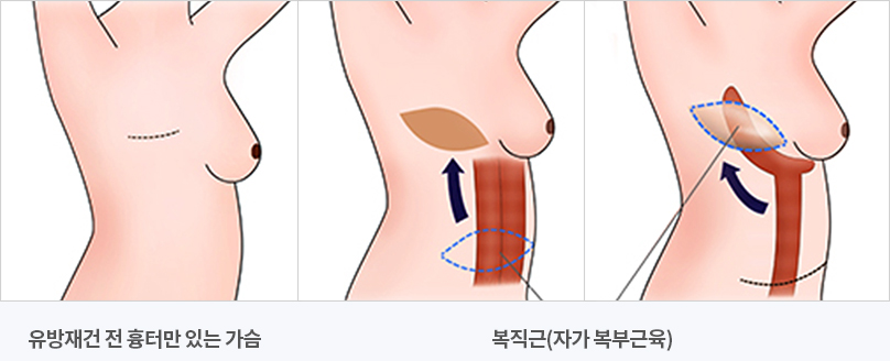 당뇨병 진단