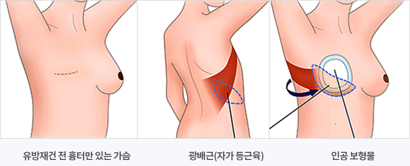 당뇨병 진단