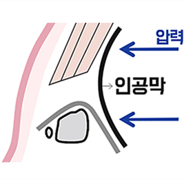 복강경 수술 시 압력 분산