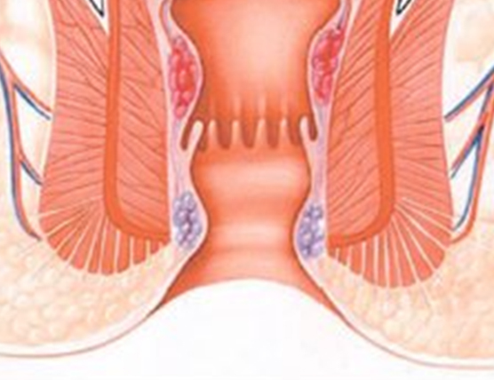 항문병 수술 후