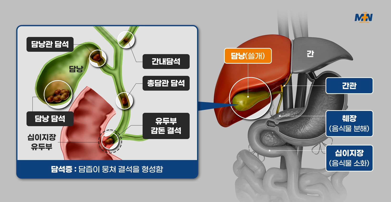 민병원 담낭센터