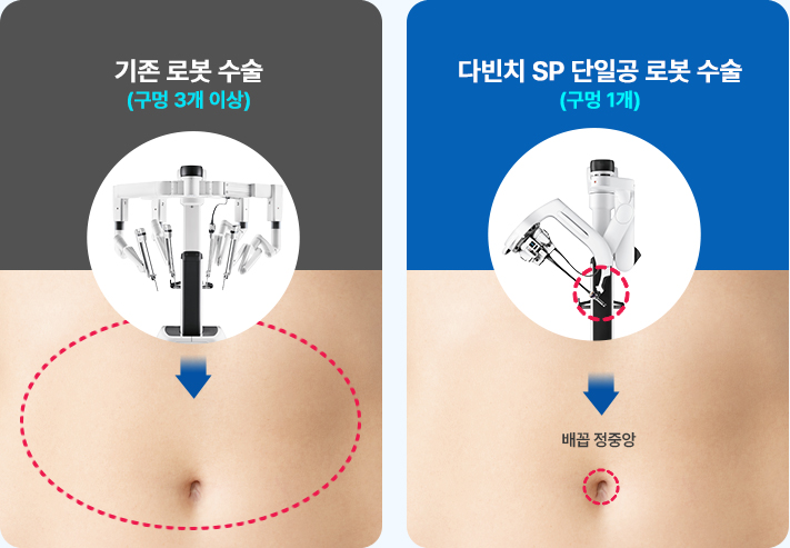 최신 로봇 수술 시스템 도입