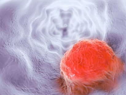 신경초종(Schwannoma)