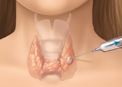 세침흡인세포검사(FNA) / 조직검사