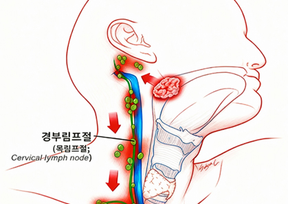 HPV 및 림프절 전이 검사