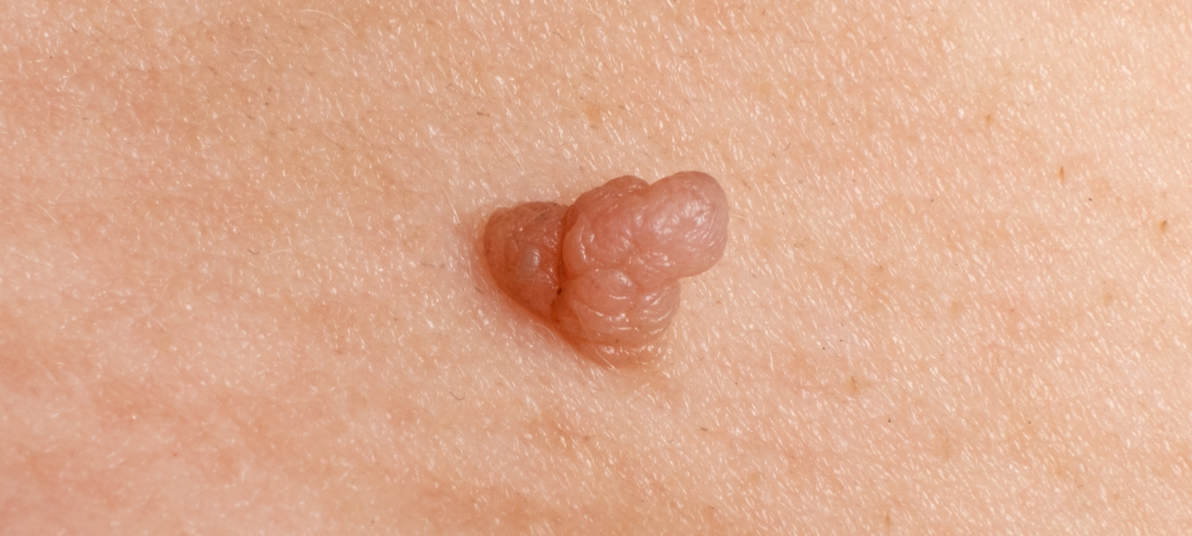 민병원 피부 양성종양센터
